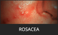 Rosacea