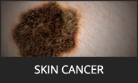 Skin Cancer