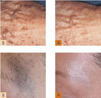 MedLite C6 Laser