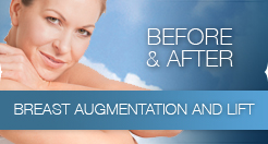 BreastAugandLiftBA