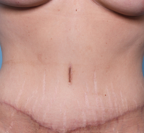 Abdominoplasty After