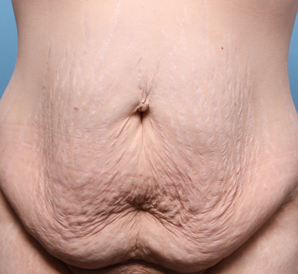 Abdominoplasty Before