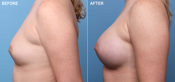 Breast Augmentation