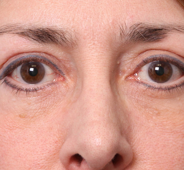 Eyelid Surgery After