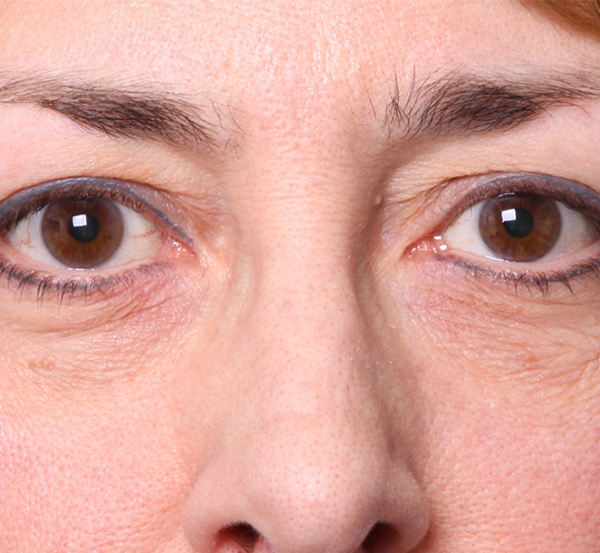 Eyelid Surgery Before