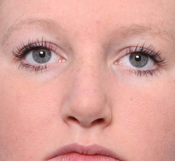 Nose Reconstruction After