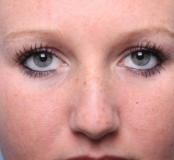 Nose Reconstruction Before