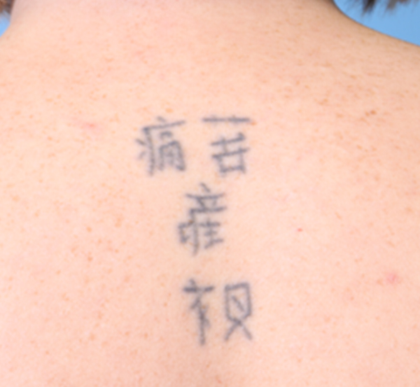 Tattoo Removal Before