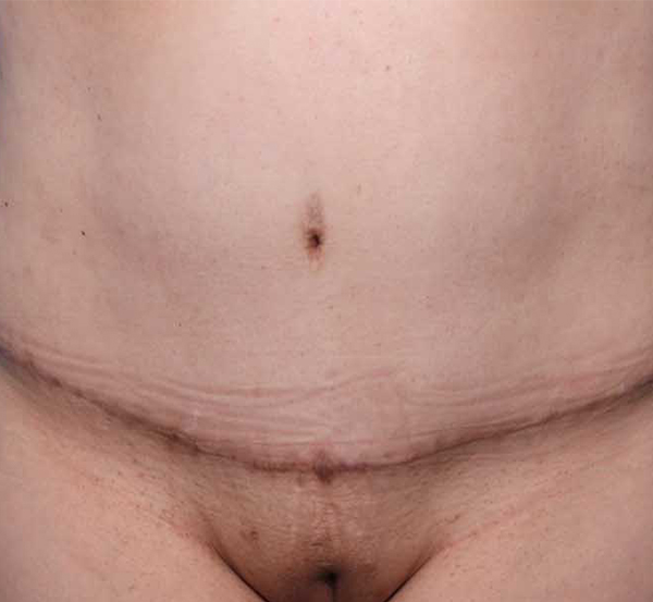 TUMMY TUCK After