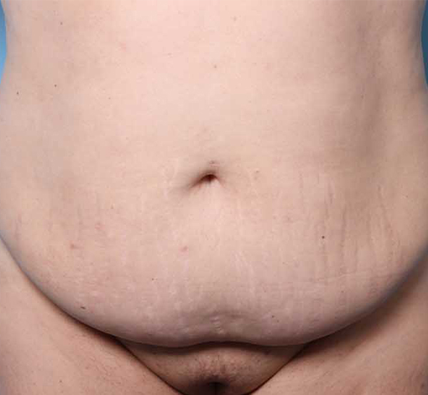 TUMMY TUCK Before