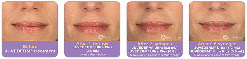 juvederm