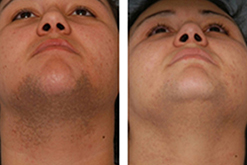 laser hair removal before and after face