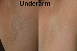 Laser Hair Removal Meridiem DermSpa Services by Treatment Type