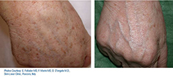 photorejuvenation before and after