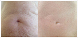 microneedling